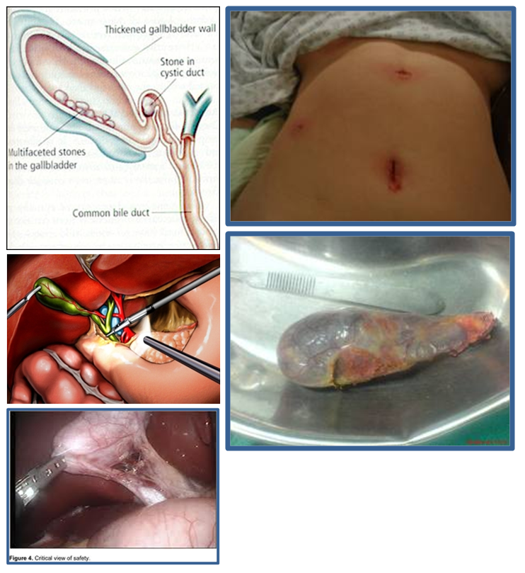 gallbladder stones operation video